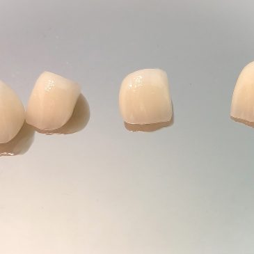 Coroane dentare E-max